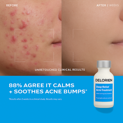 Delorien® Deep Relief Acne Treatment